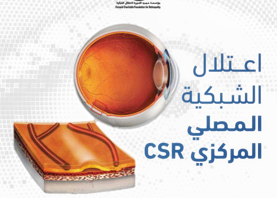 Central CSR serous retinopathy