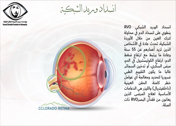 Obsolution of retina