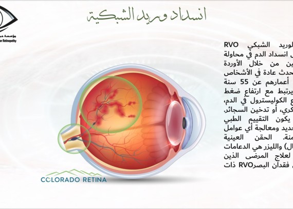 Obsolution of retina