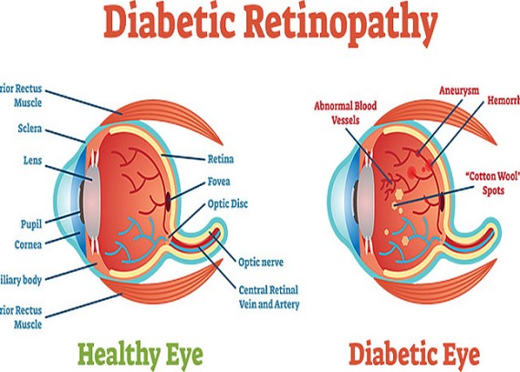 “diabetic retinopathy treatment market growth”.